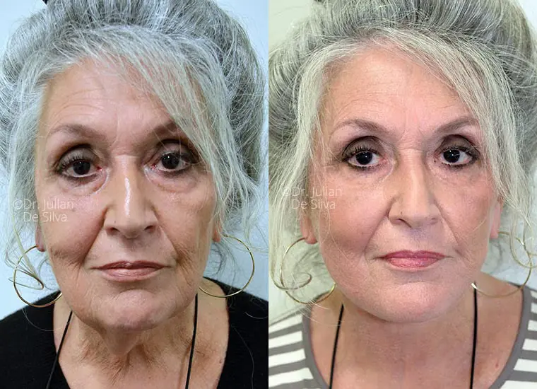Before and after VFR-7 deep plane facelift showing facial structure and jawline improvement