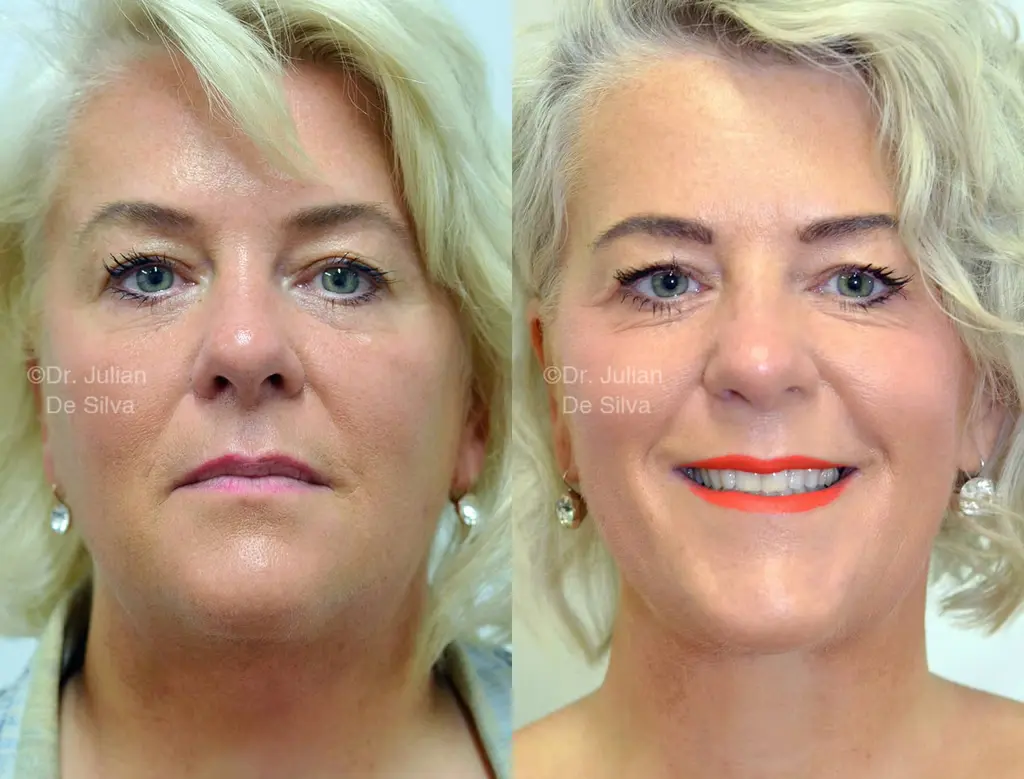 Before and after deep plane facelift result showing improved jawline and neck definition