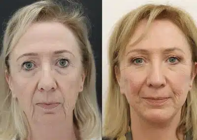 Natural-looking facelift before and after result by Dr Julian De Silva in London